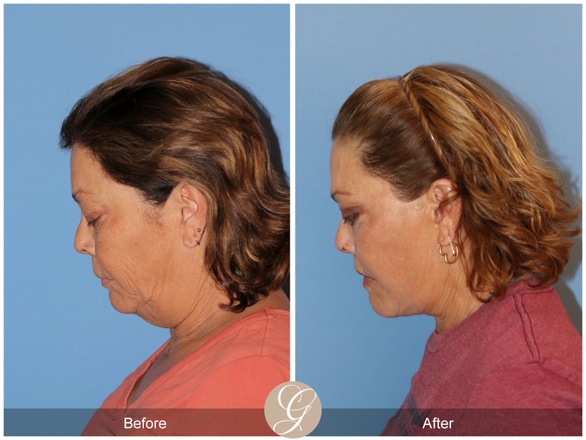 Deep Plane Facelift Before & After Gallery - Patient 376999 - Image 10