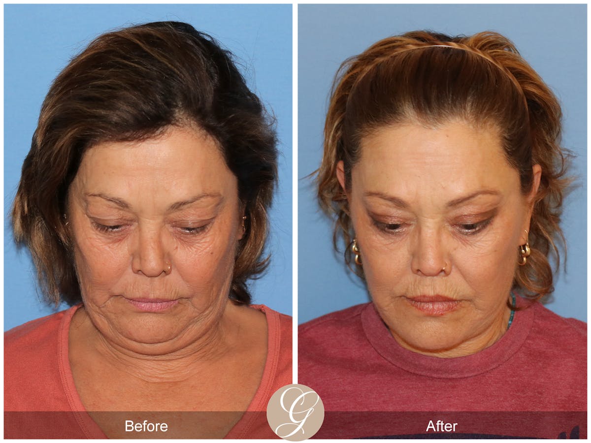 Deep Plane Facelift Before & After Gallery - Patient 376999 - Image 2