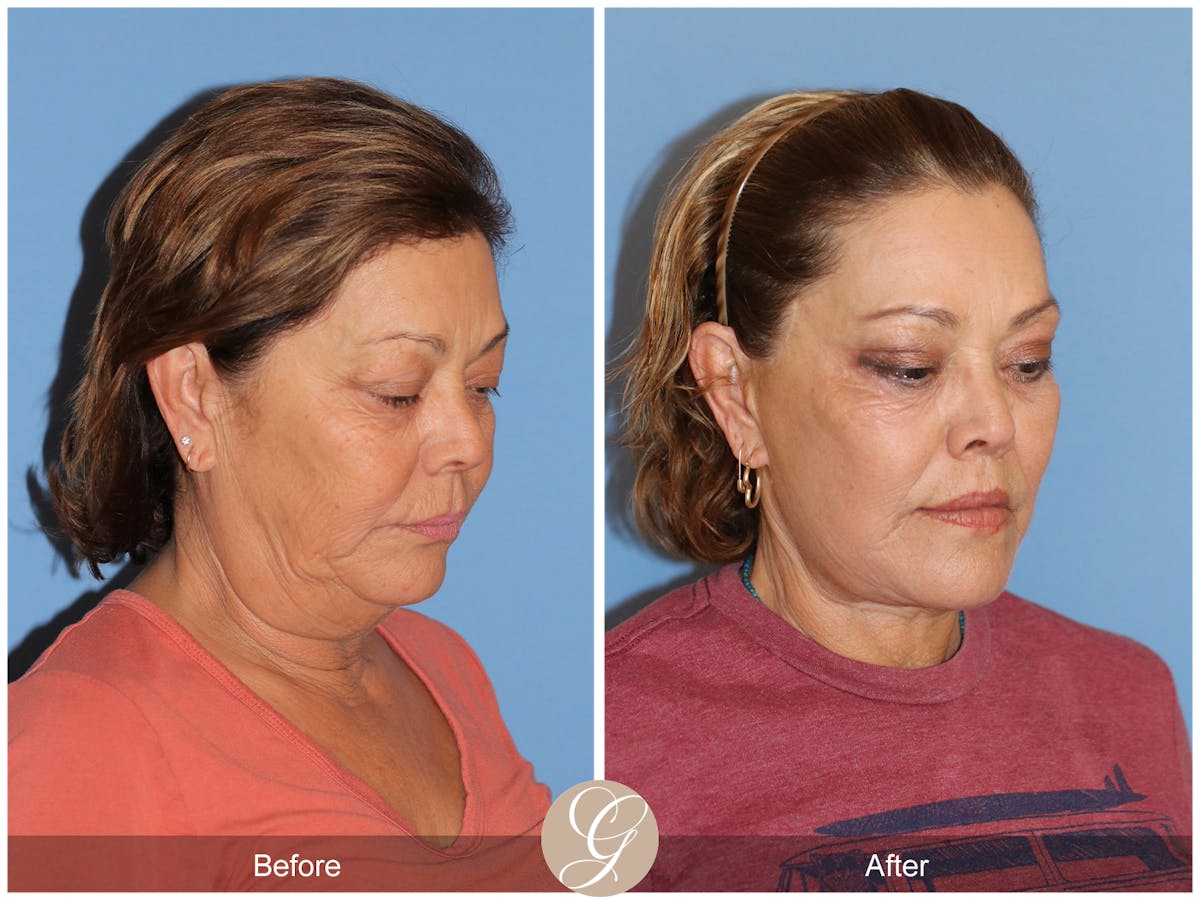 Deep Plane Facelift Before & After Gallery - Patient 376999 - Image 4