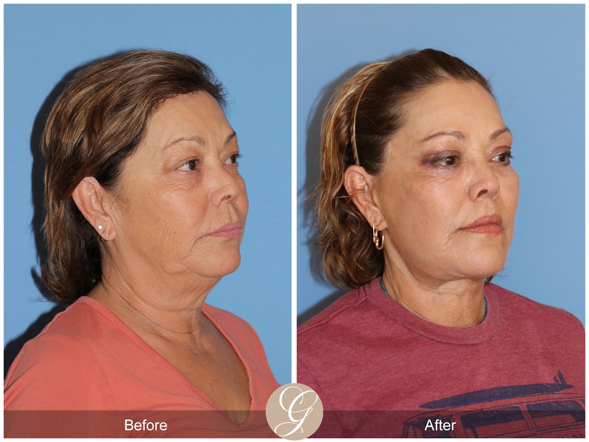 Deep Plane Facelift Before & After Gallery - Patient 376999 - Image 3