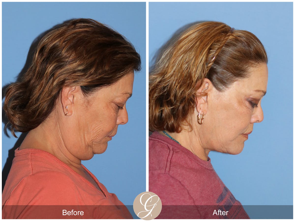 Deep Plane Facelift Before & After Gallery - Patient 376999 - Image 6