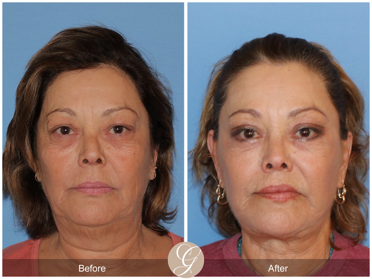 Deep Plane Facelift Before & After Gallery - Patient 376999 - Image 1