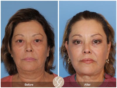 Deep Plane Facelift Before & After Gallery - Patient 376999 - Image 1