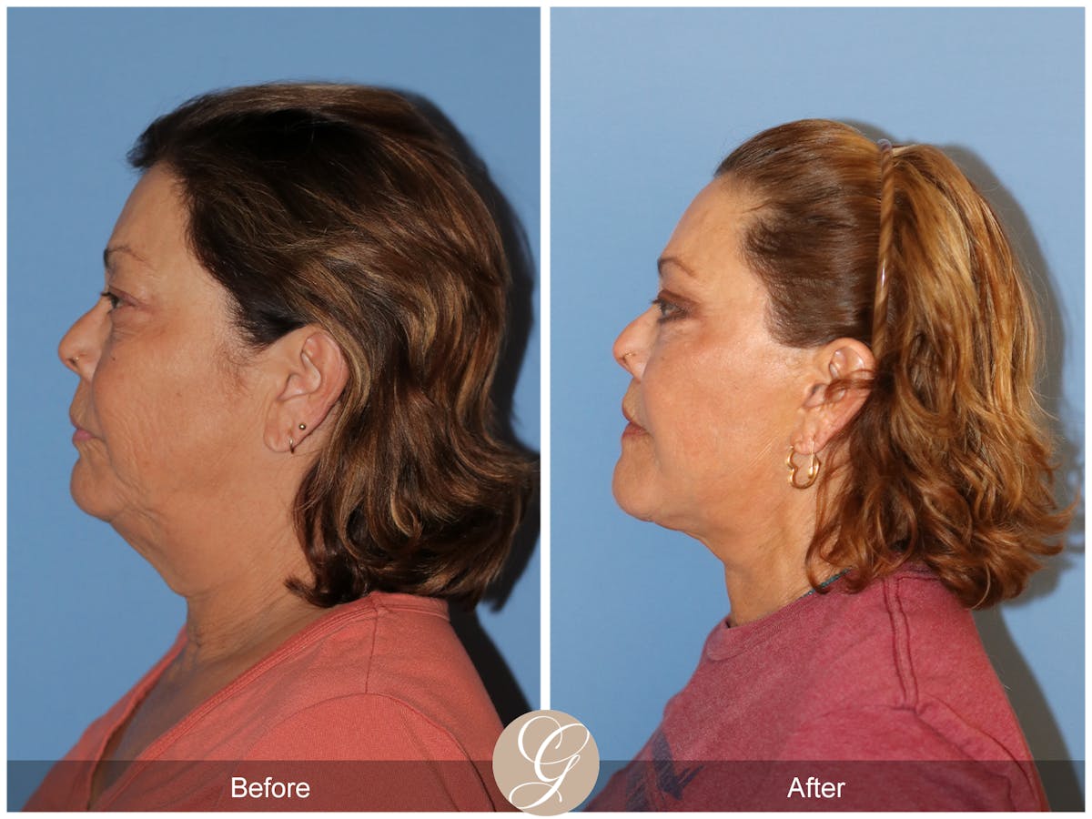 Deep Plane Facelift Before & After Gallery - Patient 376999 - Image 9