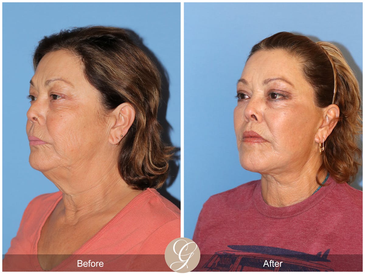 Deep Plane Facelift Before & After Gallery - Patient 376999 - Image 7