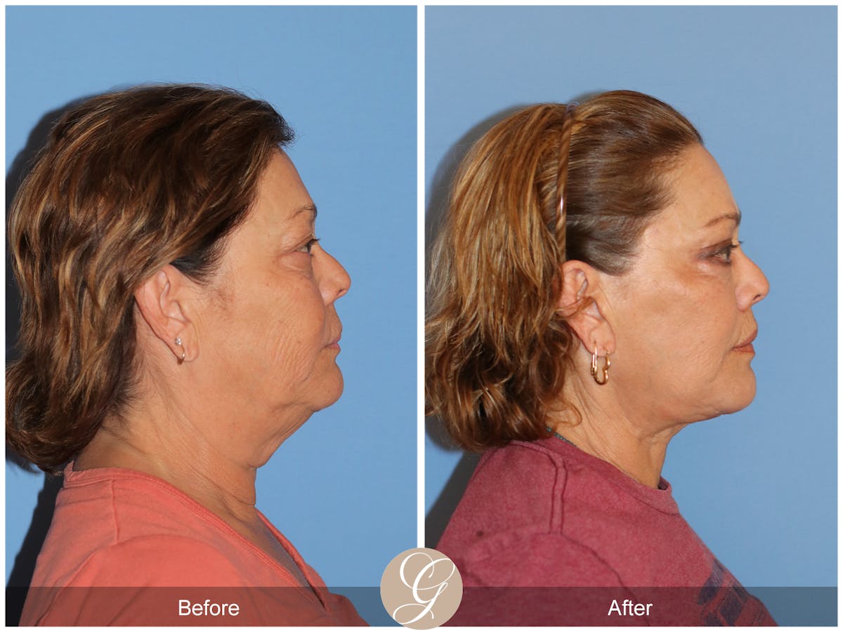 Deep Plane Facelift Before & After Gallery - Patient 376999 - Image 5
