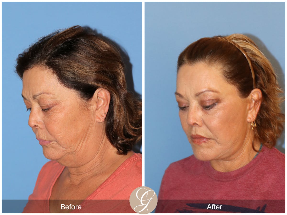Deep Plane Facelift Before & After Gallery - Patient 376999 - Image 8