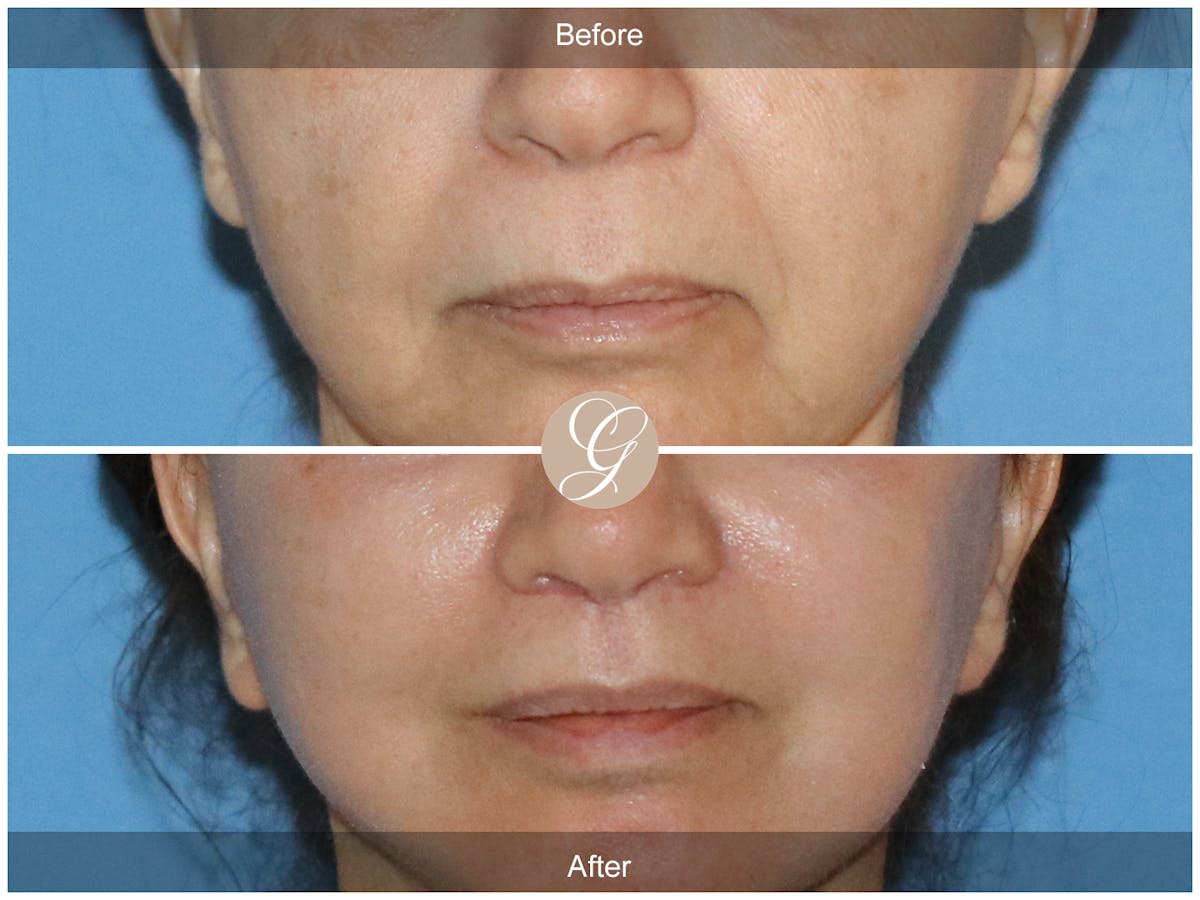Lip Lift Before & After Gallery - Patient 367526 - Image 1