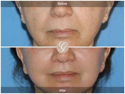 Lip Lift Before & After Gallery - Patient 367526 - Image 1
