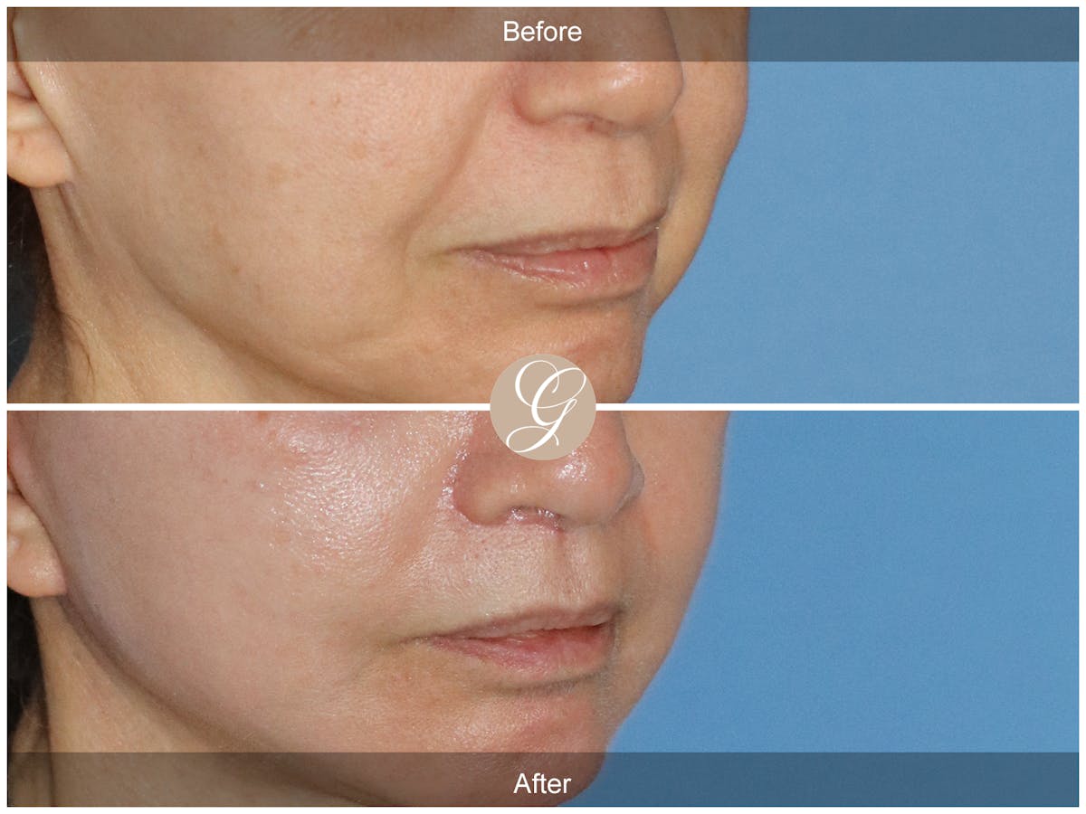 Lip Lift Before & After Gallery - Patient 367526 - Image 2