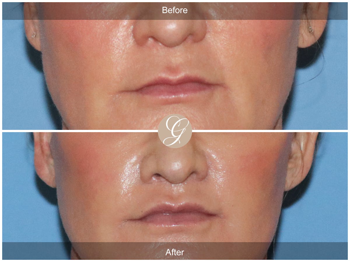 Lip Lift Before & After Gallery - Patient 586212 - Image 1