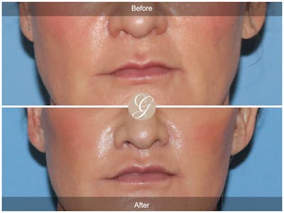 Lip Lift Before & After Gallery - Patient 586212 - Image 1