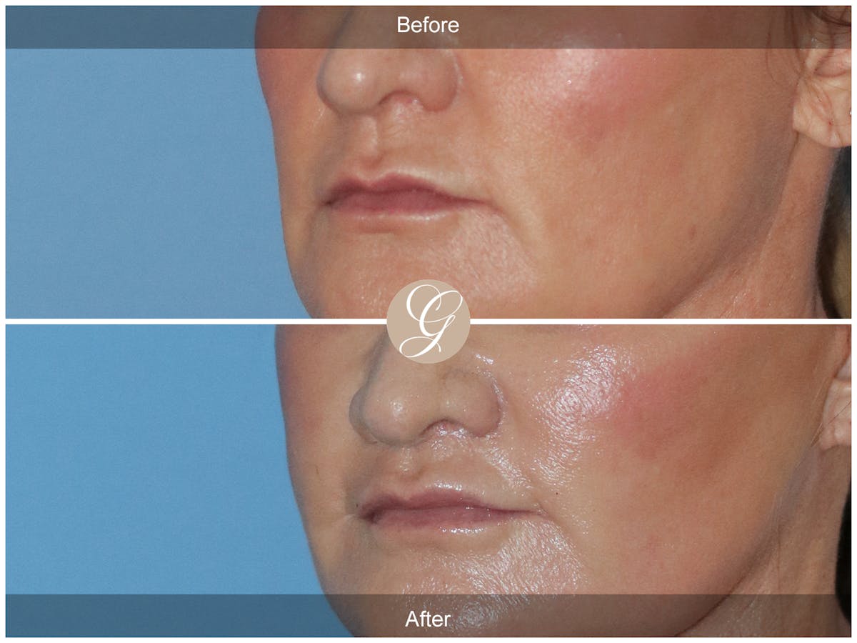 Lip Lift Before & After Gallery - Patient 586212 - Image 2