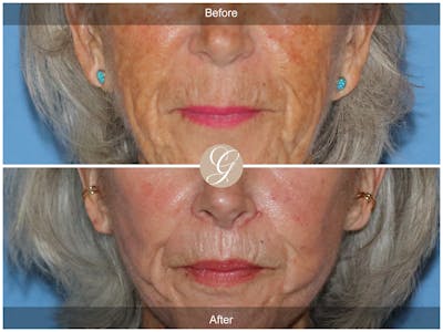 Lip Lift Before & After Gallery - Patient 353545 - Image 1