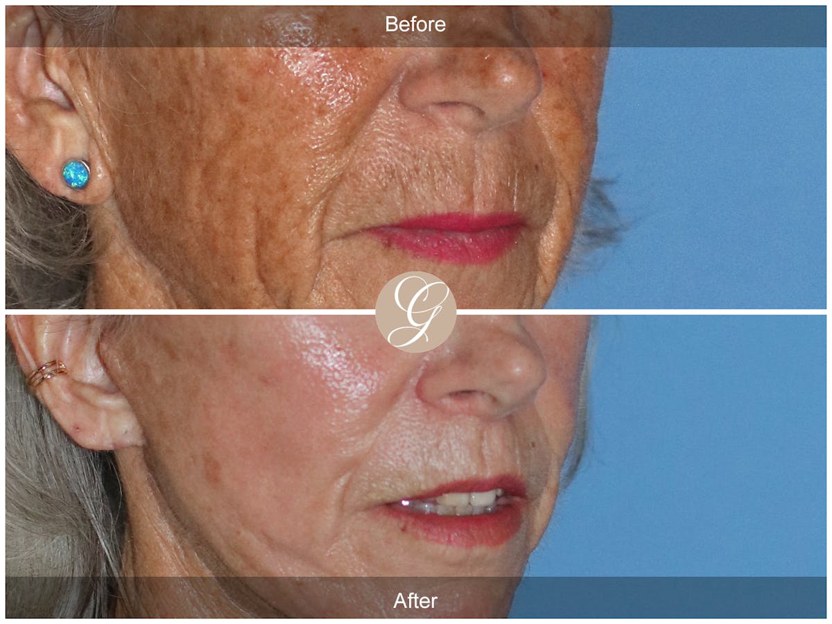 Lip Lift Before & After Gallery - Patient 353545 - Image 2