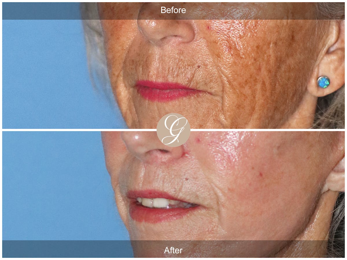 Lip Lift Before & After Gallery - Patient 353545 - Image 3