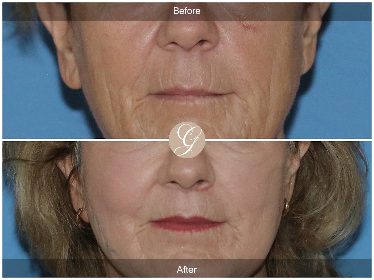 Lip Lift Before & After Gallery - Patient 250495 - Image 1