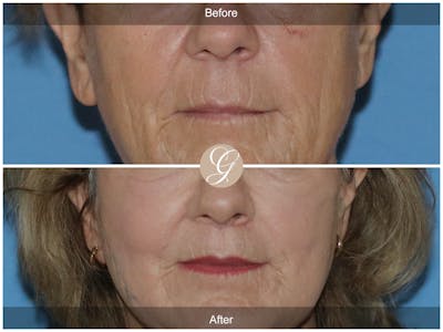 Lip Lift Before & After Gallery - Patient 250495 - Image 1