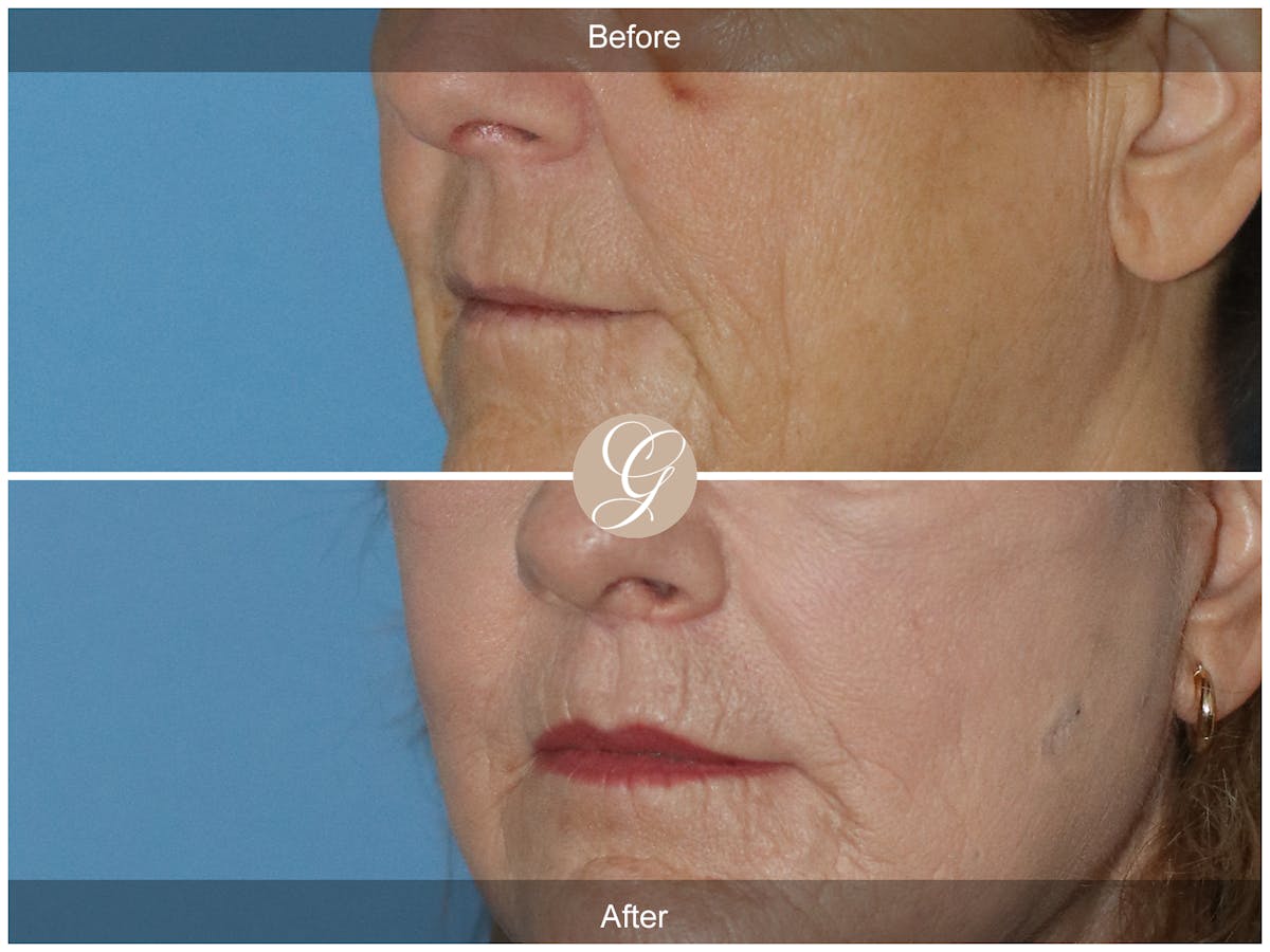 Lip Lift Before & After Gallery - Patient 250495 - Image 2