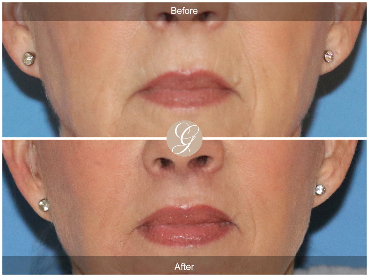 Lip Lift Before & After Gallery - Patient 318795 - Image 1