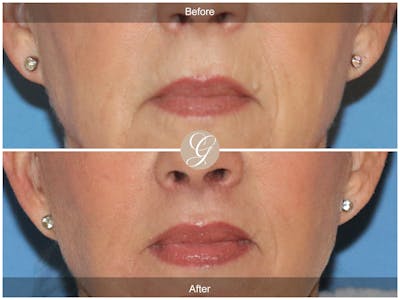 Lip Lift Before & After Gallery - Patient 318795 - Image 1