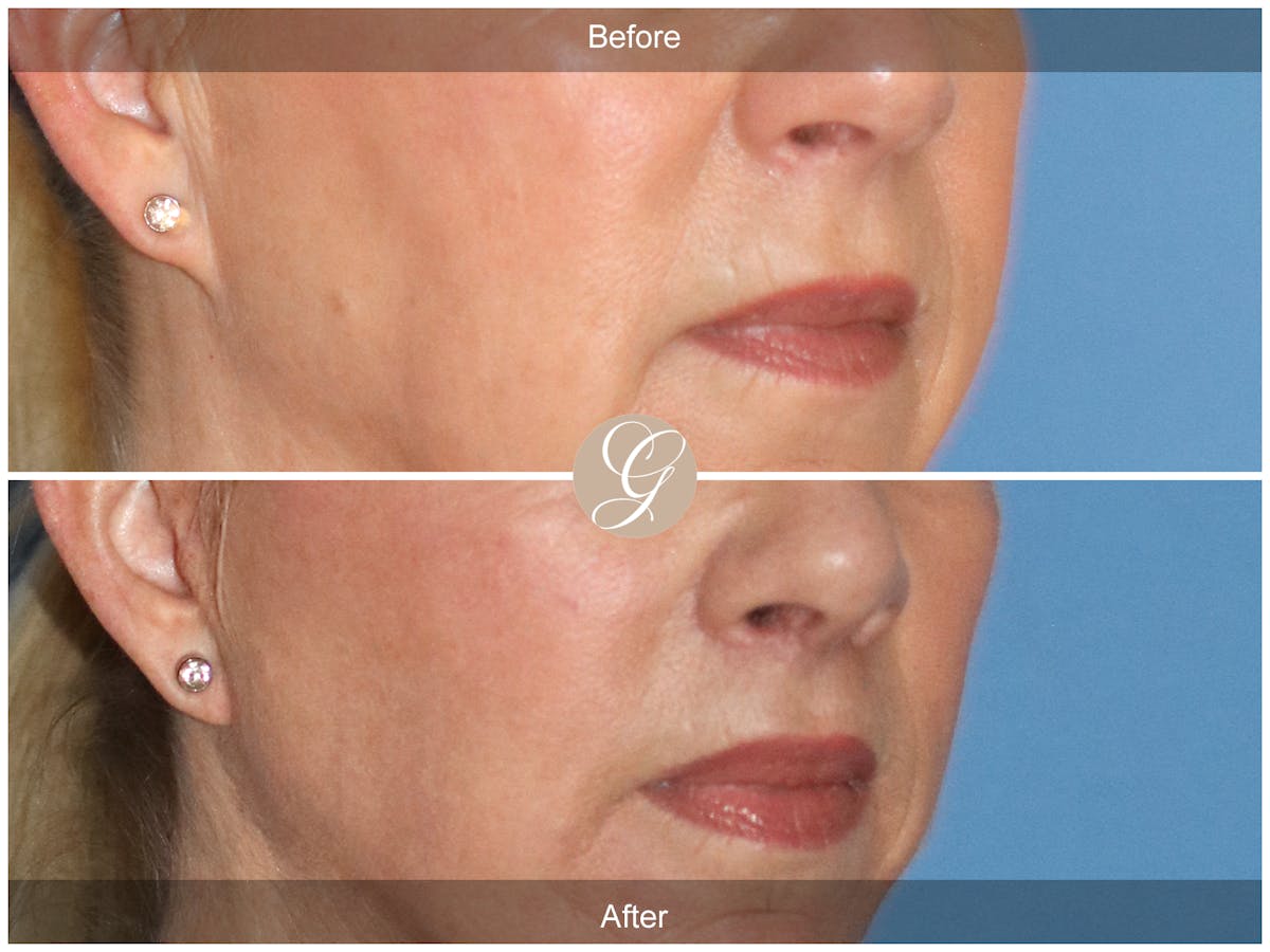 Lip Lift Before & After Gallery - Patient 318795 - Image 2