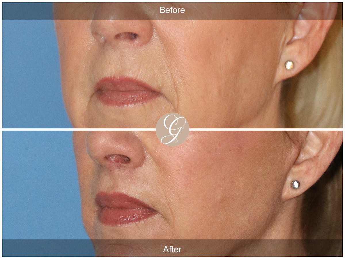 Lip Lift Before & After Gallery - Patient 318795 - Image 3