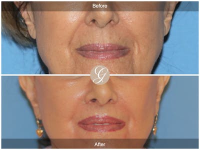 Lip Lift Before & After Gallery - Patient 207638 - Image 1