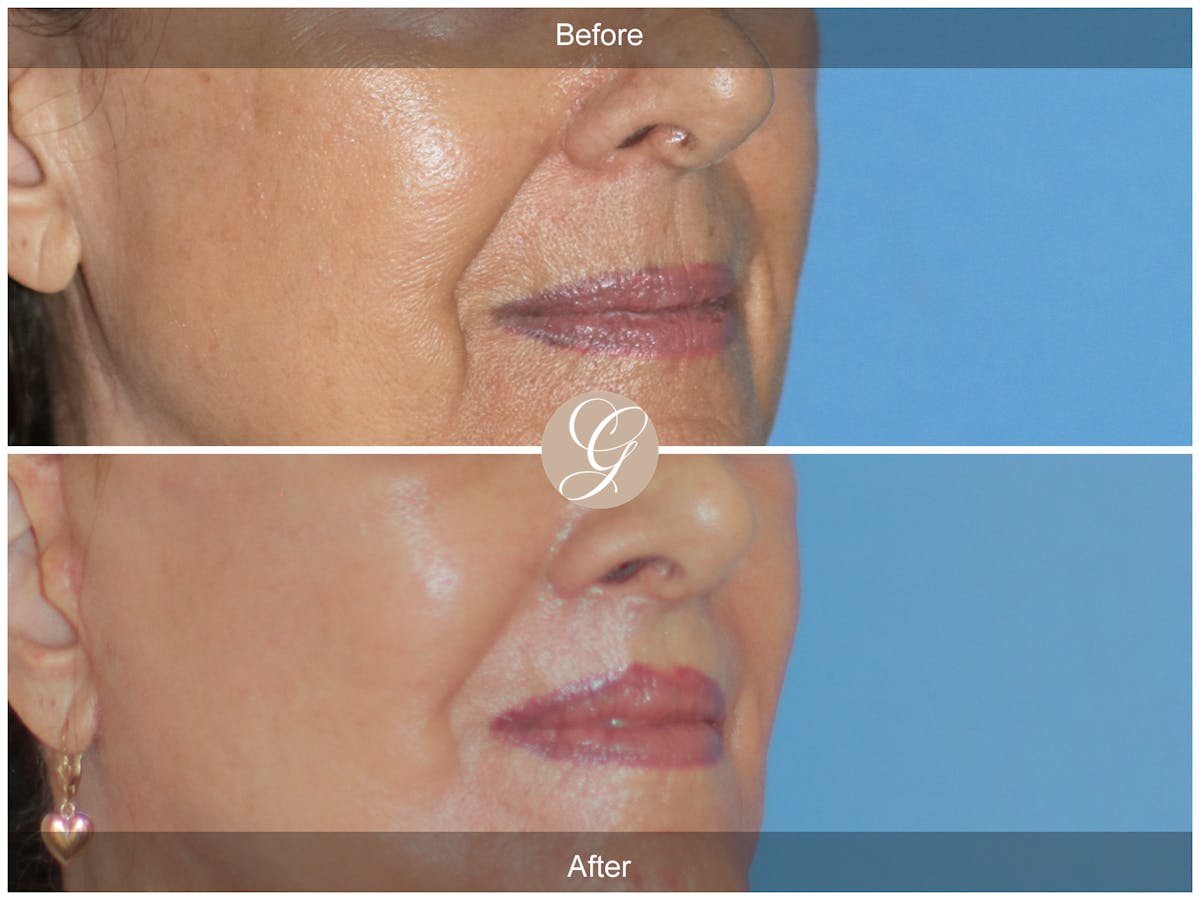 Lip Lift Before & After Gallery - Patient 207638 - Image 2