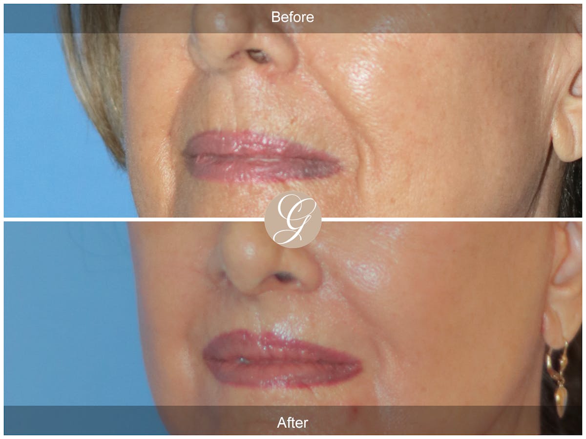 Lip Lift Before & After Gallery - Patient 207638 - Image 3