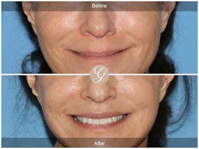 Lip Lift Before & After Gallery - Patient 381140 - Image 1