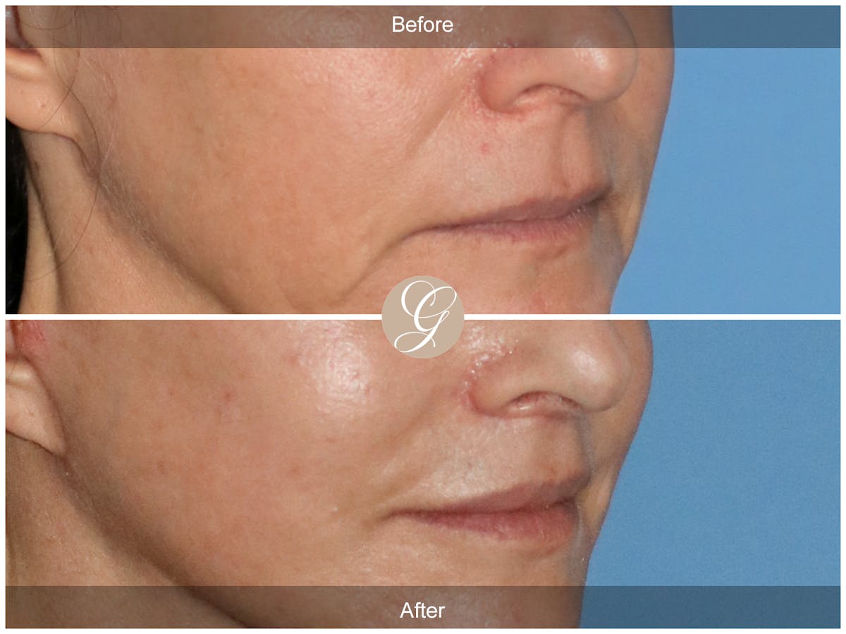 Lip Lift Before & After Gallery - Patient 381140 - Image 2