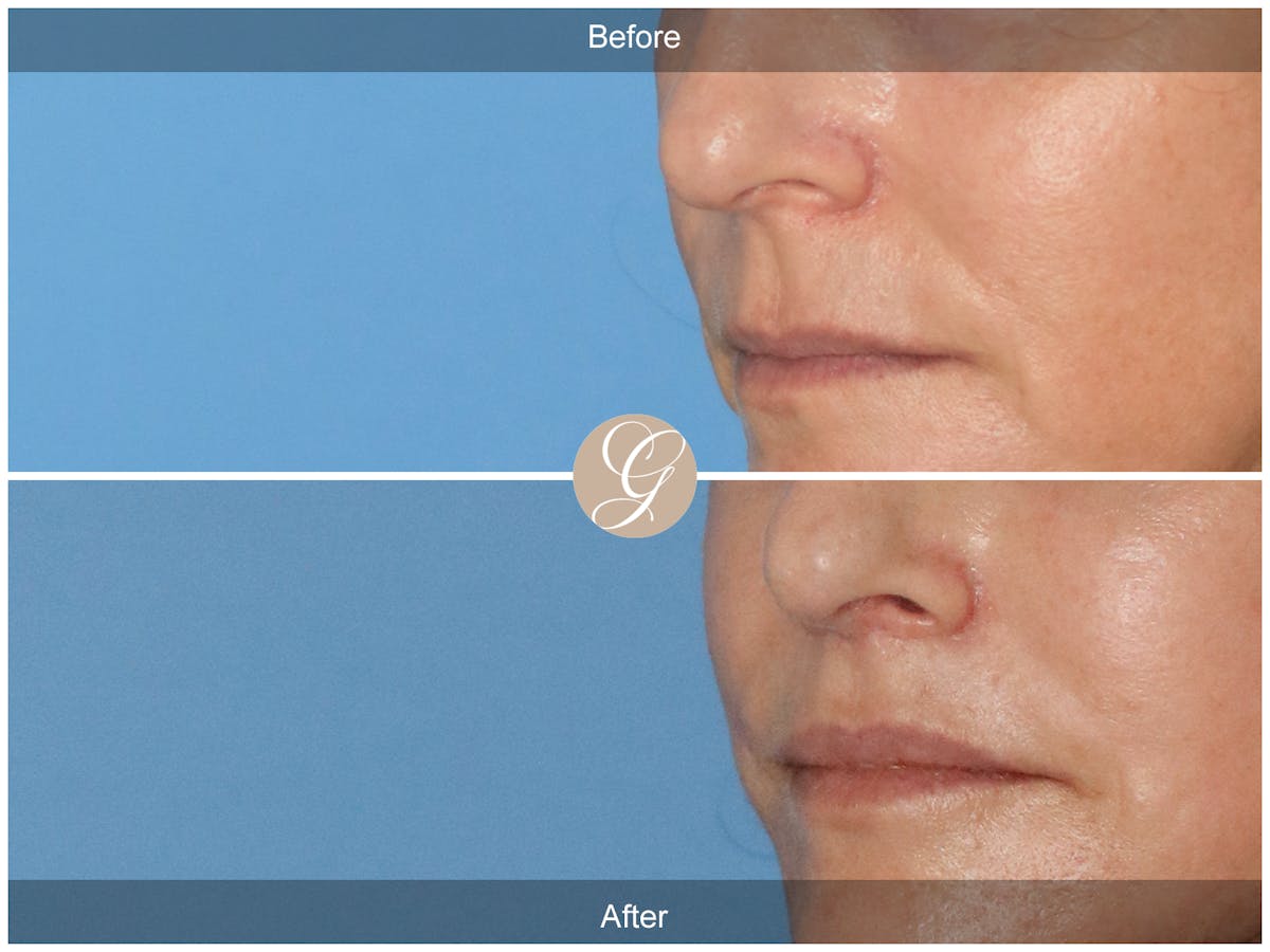 Lip Lift Before & After Gallery - Patient 381140 - Image 3