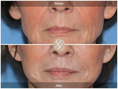 Lip Lift Before & After Gallery - Patient 314770 - Image 1