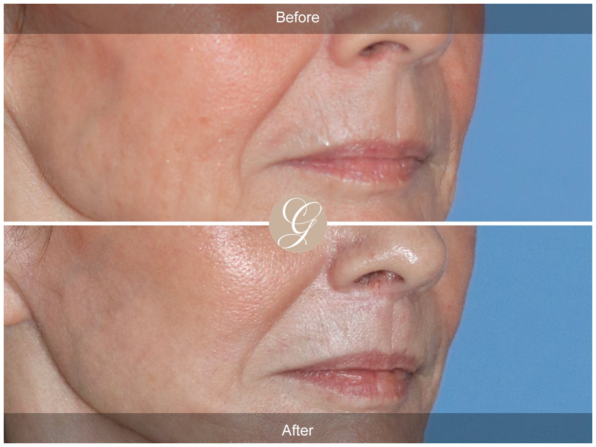 Lip Lift Before & After Gallery - Patient 314770 - Image 2