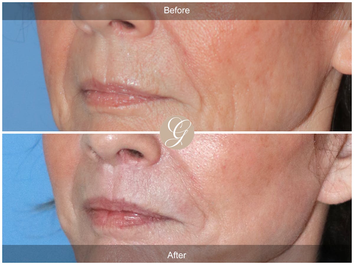 Lip Lift Before & After Gallery - Patient 314770 - Image 3