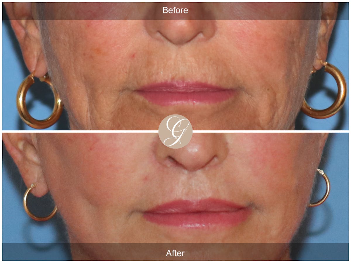Lip Lift Before & After Gallery - Patient 130806 - Image 1