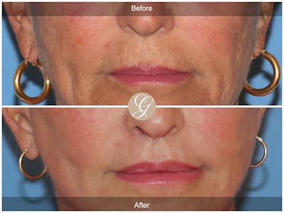 Lip Lift Before & After Gallery - Patient 130806 - Image 1