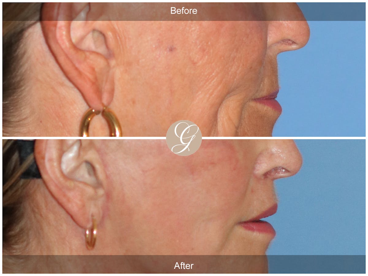 Lip Lift Before & After Gallery - Patient 130806 - Image 2
