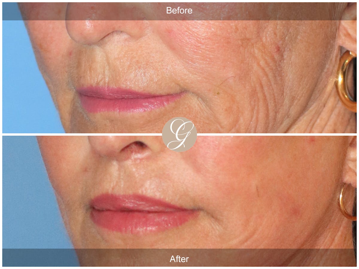 Lip Lift Before & After Gallery - Patient 130806 - Image 3