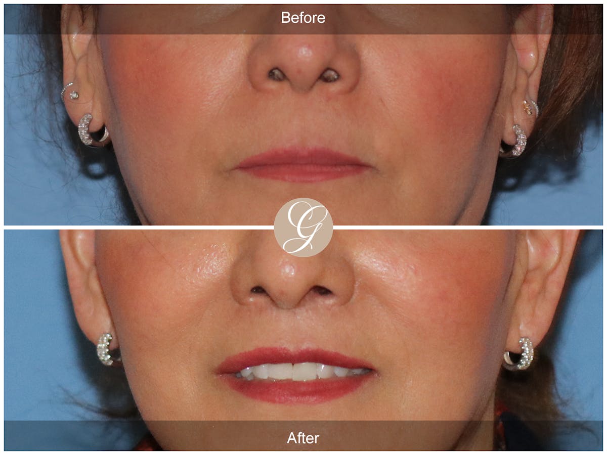 Lip Lift Before & After Gallery - Patient 387936 - Image 1