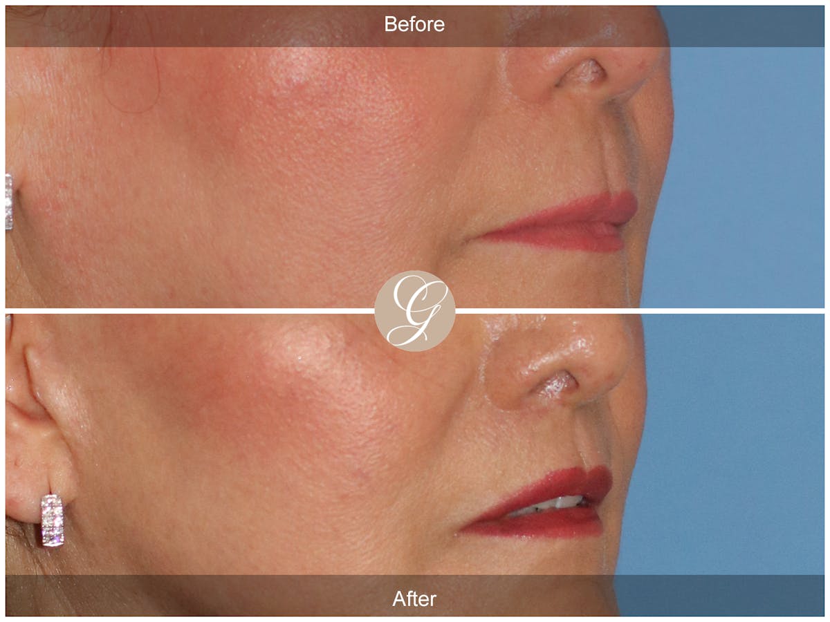Lip Lift Before & After Gallery - Patient 387936 - Image 2