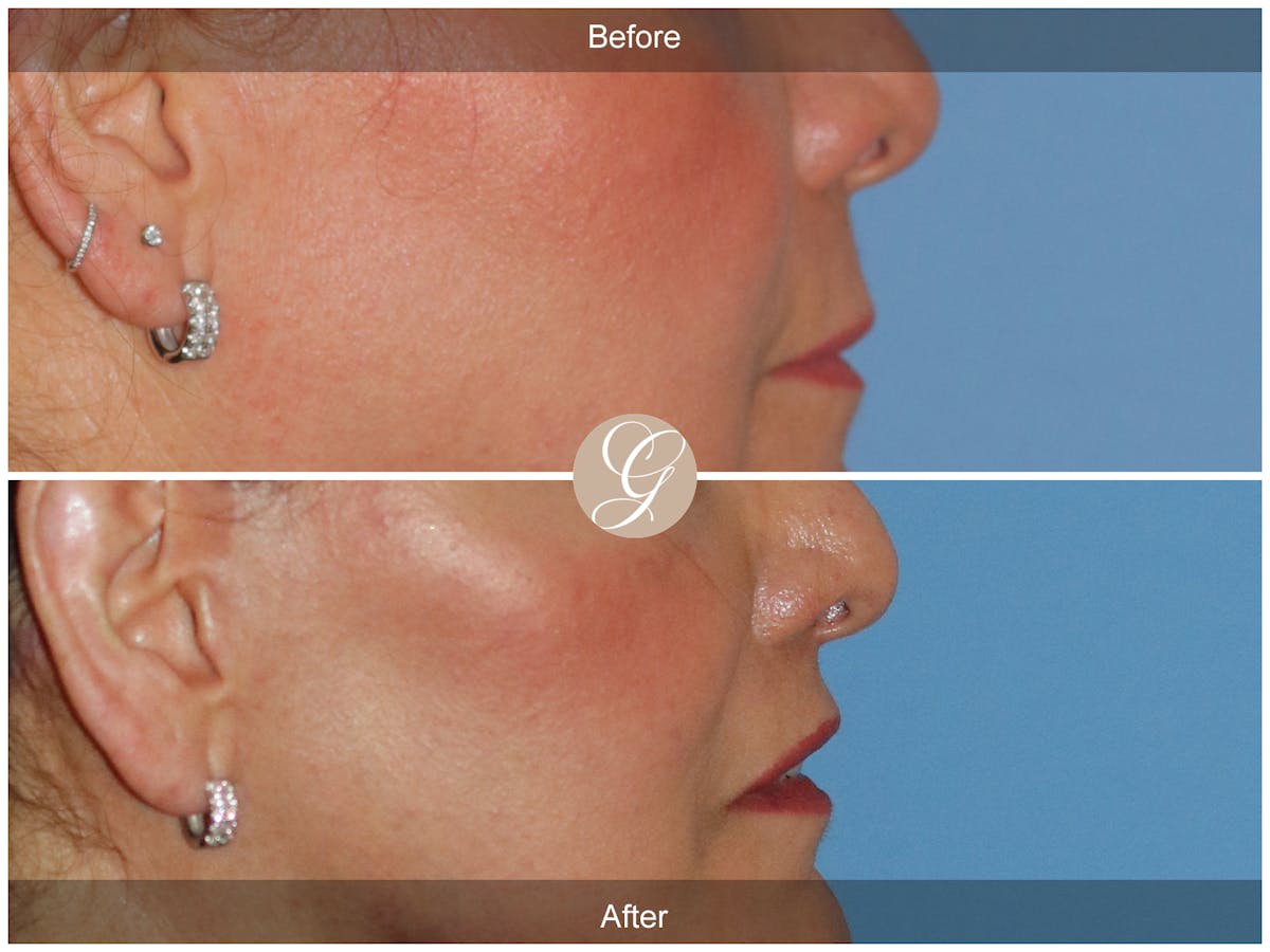 Lip Lift Before & After Gallery - Patient 387936 - Image 3