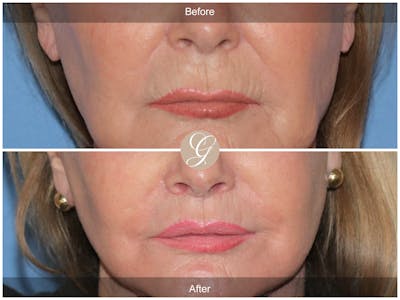 Lip Lift Before & After Gallery - Patient 333709 - Image 1