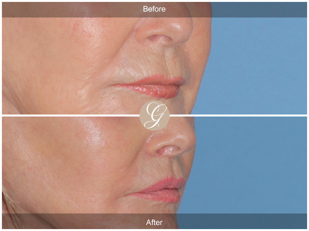 Lip Lift Before & After Gallery - Patient 333709 - Image 2