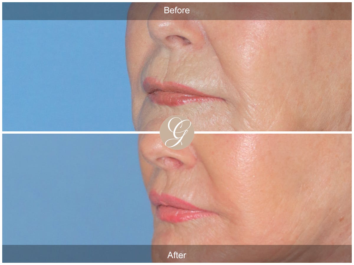 Lip Lift Before & After Gallery - Patient 333709 - Image 3