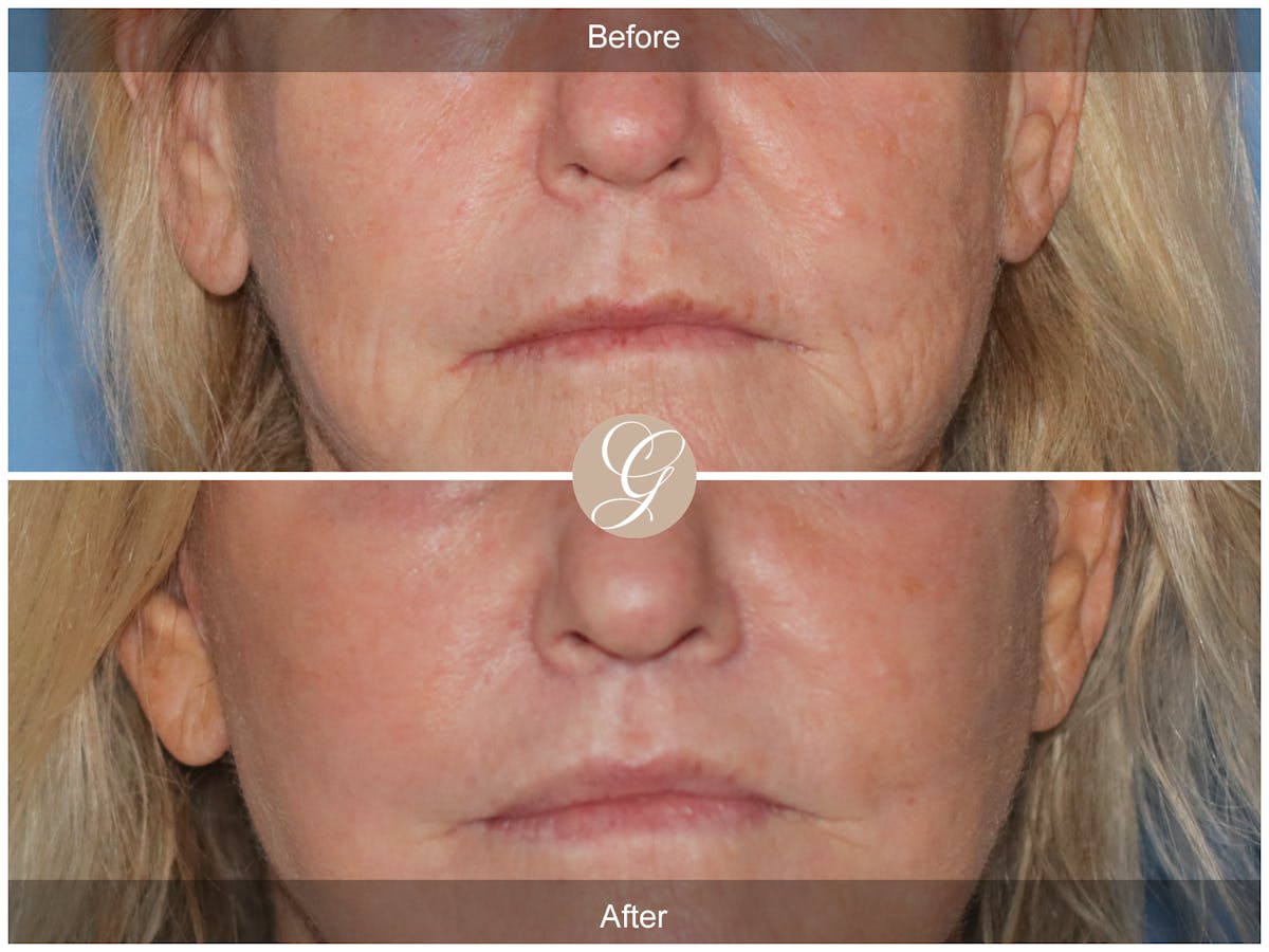 Lip Lift Before & After Gallery - Patient 327358 - Image 1