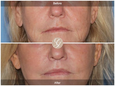 Lip Lift Before & After Gallery - Patient 327358 - Image 1