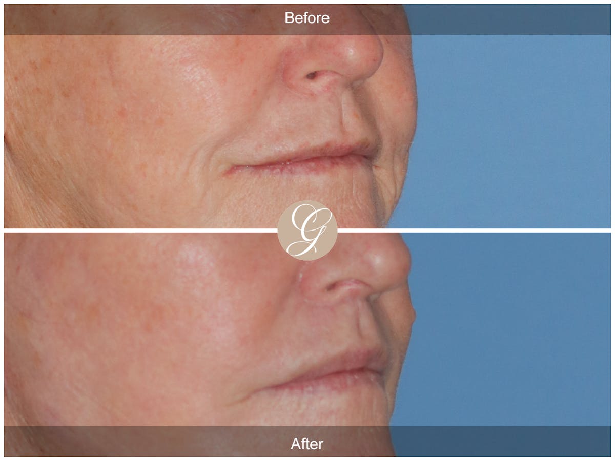 Lip Lift Before & After Gallery - Patient 327358 - Image 2