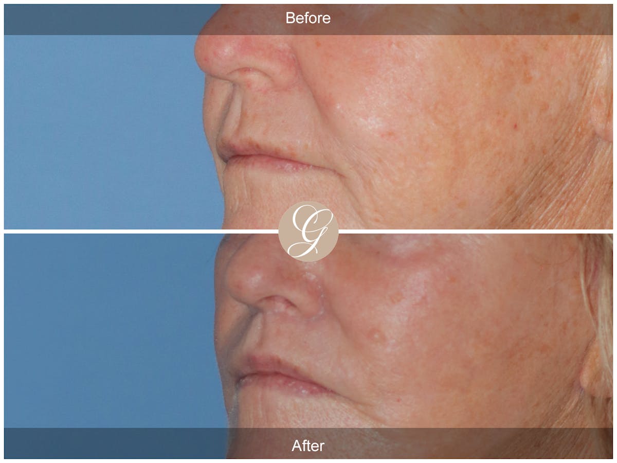 Lip Lift Before & After Gallery - Patient 327358 - Image 3